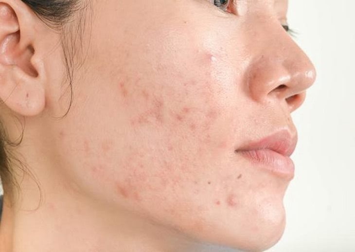trị thâm bằng laser
